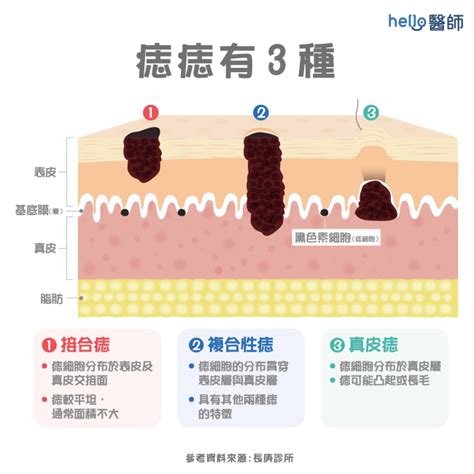 會長大的痣|痣形成的原因？痣長毛、痣變多變大是痣病變？5招判。